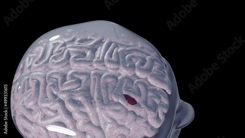 Skull with Brain Hemorrhage - BlackBG