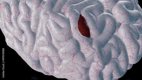 Brain Hemorrhage - BlackBG