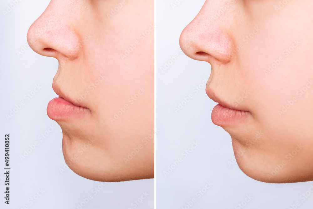 © Марина Демешко - Woman's face before and after correction of malocclusion of teeth isolated on white background. Lower jaw extended forward. Result of a correction of mesial bite with braces. Overbite dental occlusion © Марина Демешко - Woman's face before and after correction of malocclusion of teeth isolated on white background. Lower jaw extended forward. Result of a correction of mesial bite with braces. Overbite dental occlusion