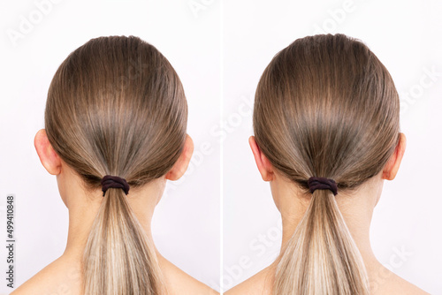 Rear view of a woman's head with ears before and after otoplasty isolated on a white background. Result of cosmetic plastic surgery to correct the auricles and get rid of lop - eared. Beauty concept photo