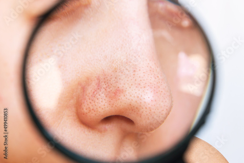 Close-up of a female nose with blackheads or black dots in a magnifying glass isolated on a white background. Acne problem, comedones. Enlarged pores on the face. Cosmetology concept