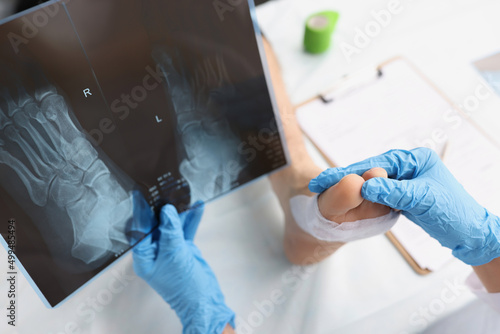 Fotografia Doctor holds x-ray with dislocated leg of patient lying on table