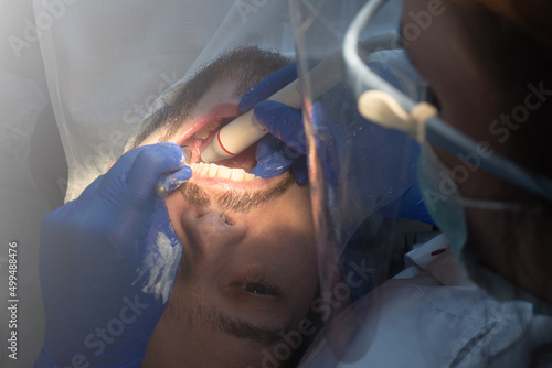 Dentist make ultrasonic teeth cleaning close-up. Removal of tartar and plaque. prevention of dental disease paradontitis and paradantoz.  photo