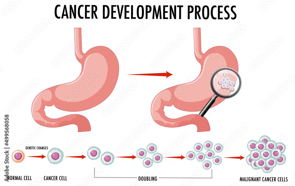 Obraz premium Diagram showing normal and cancer cells in human