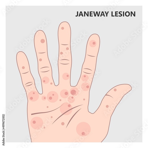 Acute aortic mitral valve bacteria fungi germs fever gum sepsis and Osler nodes insufficiency chest pain murmur sound palms hand skin rash nails eye with Roth spot