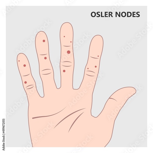 Acute aortic mitral valve bacteria fungi germs fever gum sepsis and Osler nodes insufficiency chest pain murmur sound palms hand skin rash nails eye with Roth spot