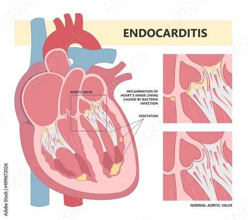 Acute aortic mitral valve bacteria fungi germs fever gum sepsis and Osler nodes insufficiency chest pain murmur sound palms hand skin rash nails eye with Roth spot