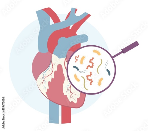 Acute aortic mitral valve bacteria fungi germs fever gum sepsis and Osler nodes insufficiency chest pain murmur sound palms hand skin rash nails eye with Roth spot