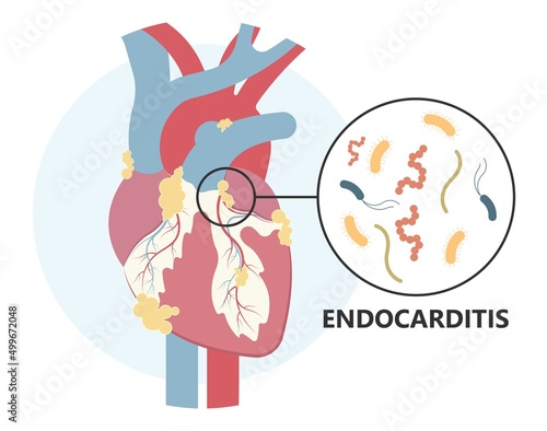 Acute aortic mitral valve bacteria fungi germs fever gum sepsis and Osler nodes insufficiency chest pain murmur sound palms hand skin rash nails eye with Roth spot