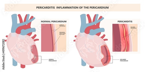 Heart attack acute chest pain injury difficulty breathing fat pads trauma fever shock viral bacterial fungal rate mRNA COVID-19 muscle dyspnea arrest unstable angina X-RAY diagnose Lupus virus cancer
