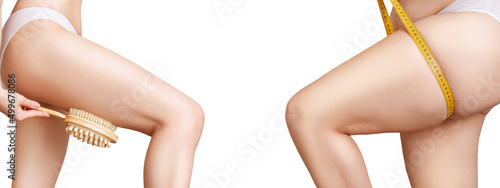 Foto Female hips before and after weight loss and cellulitis treatment