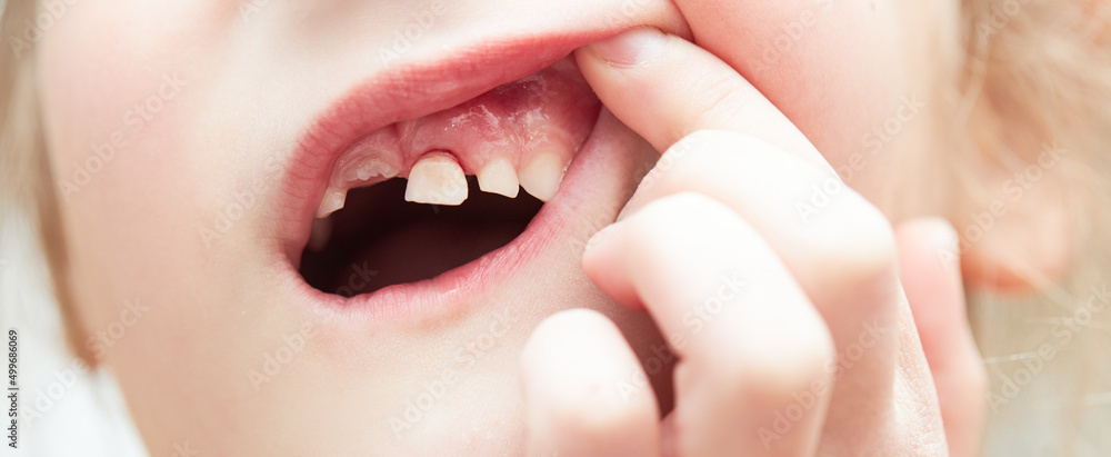 Fototapeta premium A little girl lost her baby milk tooth. Lost temporary tooth. The concept of oral hygiene in children. Close-up of the oral cavity