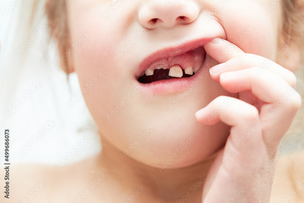 Obraz premium A little girl lost her baby milk tooth. Lost temporary tooth. The concept of oral hygiene in children. Close-up of the oral cavity