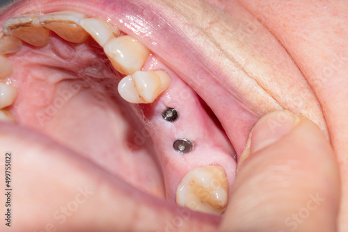 Close up on dental implant screw inserted into the gingiva.