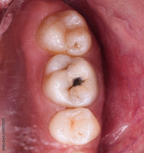 tooth filling with composite after removing the cavity