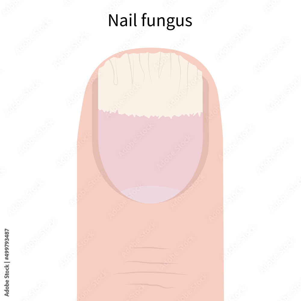 Nail fungus - Symptoms and causes - Mayo Clinic