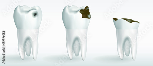 stages of caries. Stages of tooth decay. Vector realistic illustration