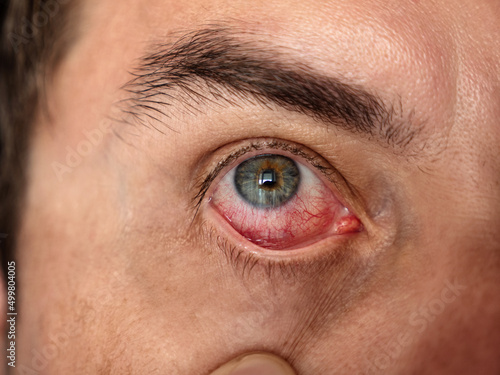 Man with red eye, macro. Conjunctivitis infection. photo