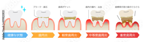 歯周病(歯肉炎)の重症度・プラーク・歯石による歯肉の腫れ・出血・歯周ポケット