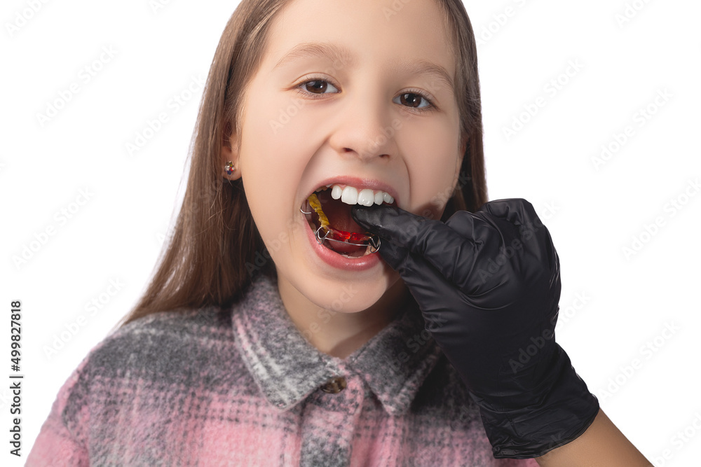 A doctor in black medical gloves tries on an orthodontic appliance for a little girl. The concept of teeth alignment in childhood. Studio photo on a white background. A doctor in black medical gloves tries on an orthodontic appliance for a little girl. The concept of teeth alignment in childhood. Studio photo on a white background.