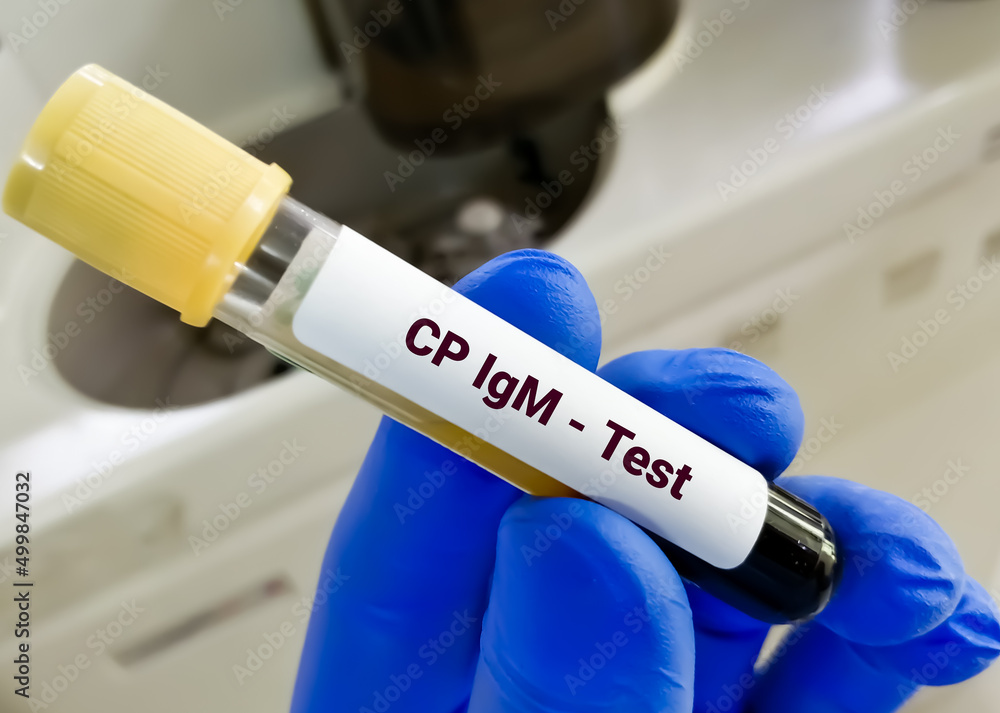 Blood sample for Chlamydia pneumoniae (CP) IgM test. Blood sample for Chlamydia pneumoniae (CP) IgM test.