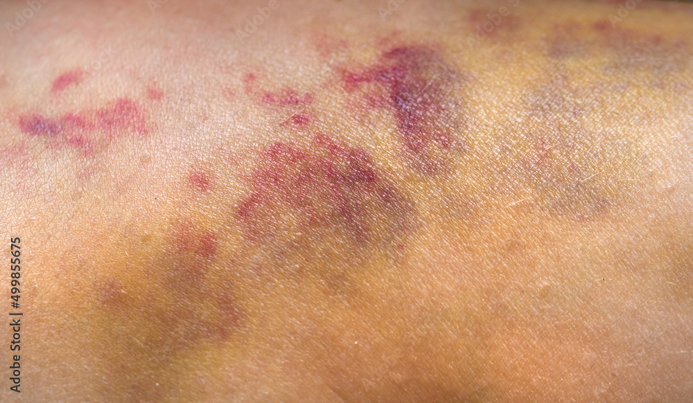 Fototapeta premium Bruises on the human body. Severe bruise from impact, bruising and hematoma.