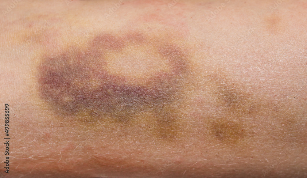 Bruises on the human body. Severe bruise from impact, bruising and hematoma.