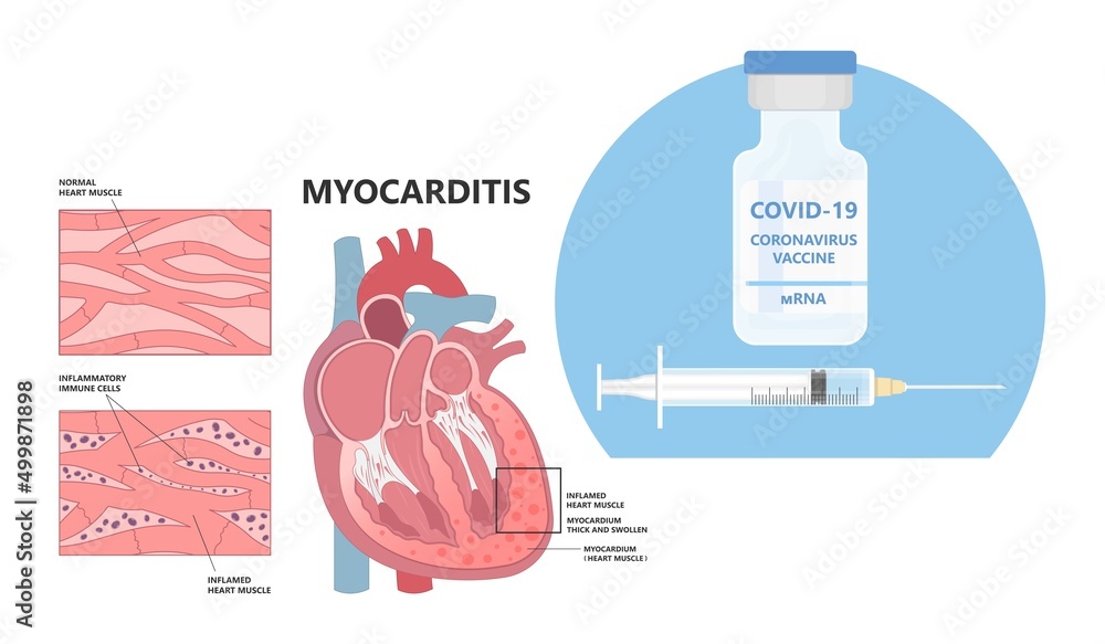 Cardiology high blood pressure Heart attack mRNA lupus viral vaccine
