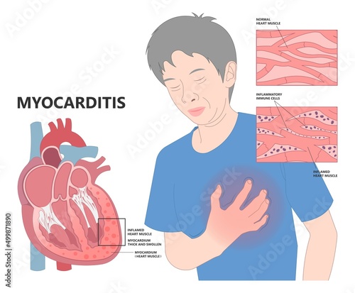 Cardiology high blood pressure Heart attack mRNA lupus viral vaccine ECG COVID-19 virus ECMO rapid chest pain leg ankles feet transplant giant cell infectious