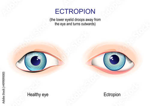 Ectropion. the lower eyelid droops away from the eye and turns outwards.
