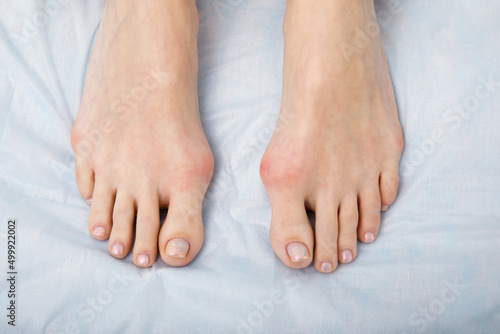The woman suffers from inflammation of the big toe bone. Hallux valgus, bunion in foot on white background.