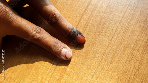 A Timorese voter with ink on finger after voting in the presidency candidate election in Dili, Timor Leste