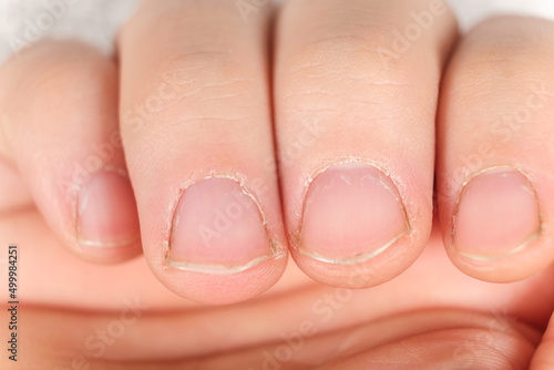 Unkempt male nails with a regrown cuticle on a white background