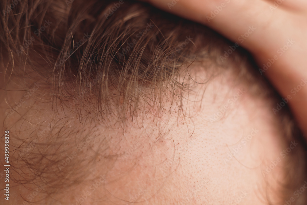 balding man is opening his forehead, close up view balding man is opening his forehead, close up view