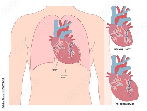 Enlarged athlete's heart angina x-ray edema test diagnose chest pain high blood pressure sudden death shock stress test