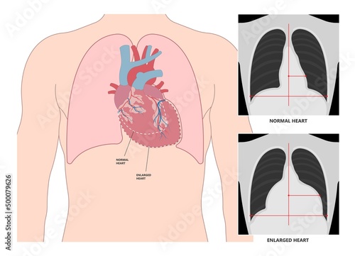 Enlarged athlete's heart angina x-ray edema test diagnose chest pain high blood pressure sudden death shock stress test