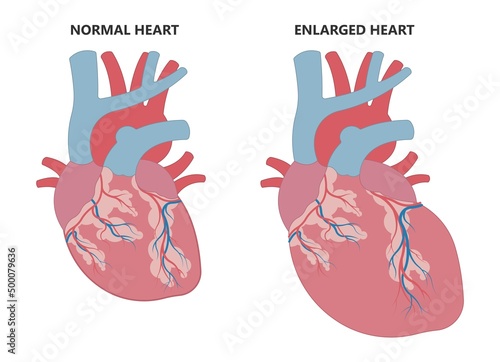 Enlarged athlete's heart angina x-ray edema test diagnose chest pain high blood pressure sudden death shock stress test
