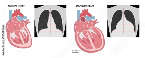 Fotografia Enlarged athlete's heart angina x-ray edema test diagnose chest pain high blood
