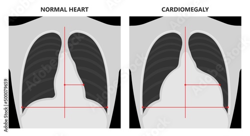 Enlarged athlete's heart angina x-ray edema test diagnose chest pain high blood pressure sudden death shock stress test