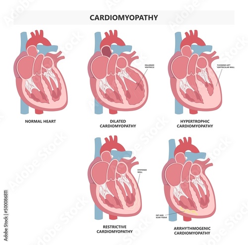 Cardiomyopathy Heart attack artery hypertrophy chamber stress stiff stretched high blood pressure valve right and left edema chest pain lupus immune system disorder arrest photo