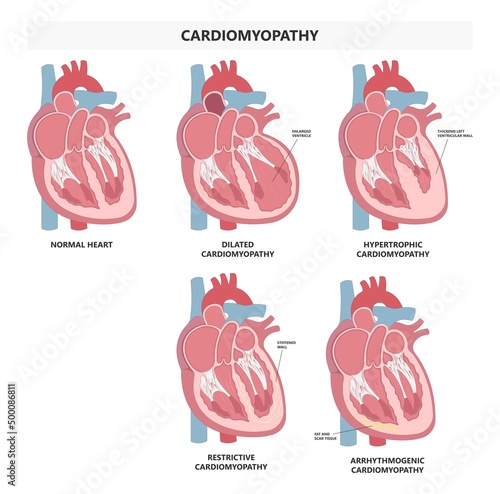 Cardiomyopathy Heart attack artery hypertrophy chamber stress stiff stretched high blood pressure valve right and left edema chest pain lupus immune system disorder arrest