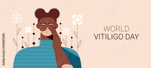 Smiling confident afro american woman with vitiligo. Vector illustration of woman taking care of her skin. World Vitiligo Day. Love yourself, accept your body. Landing page.