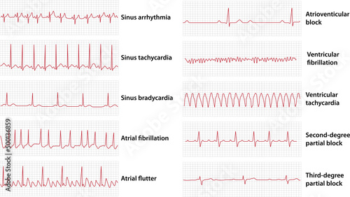 Schemes set of common electrocardiogram (ECG) abnormalities, including partial blocks and flutter photo
