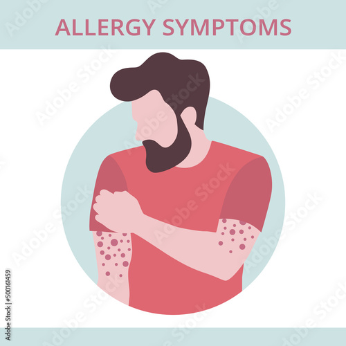 Seasonal allergy. man with red skin rash. Male scratching skin on his hand