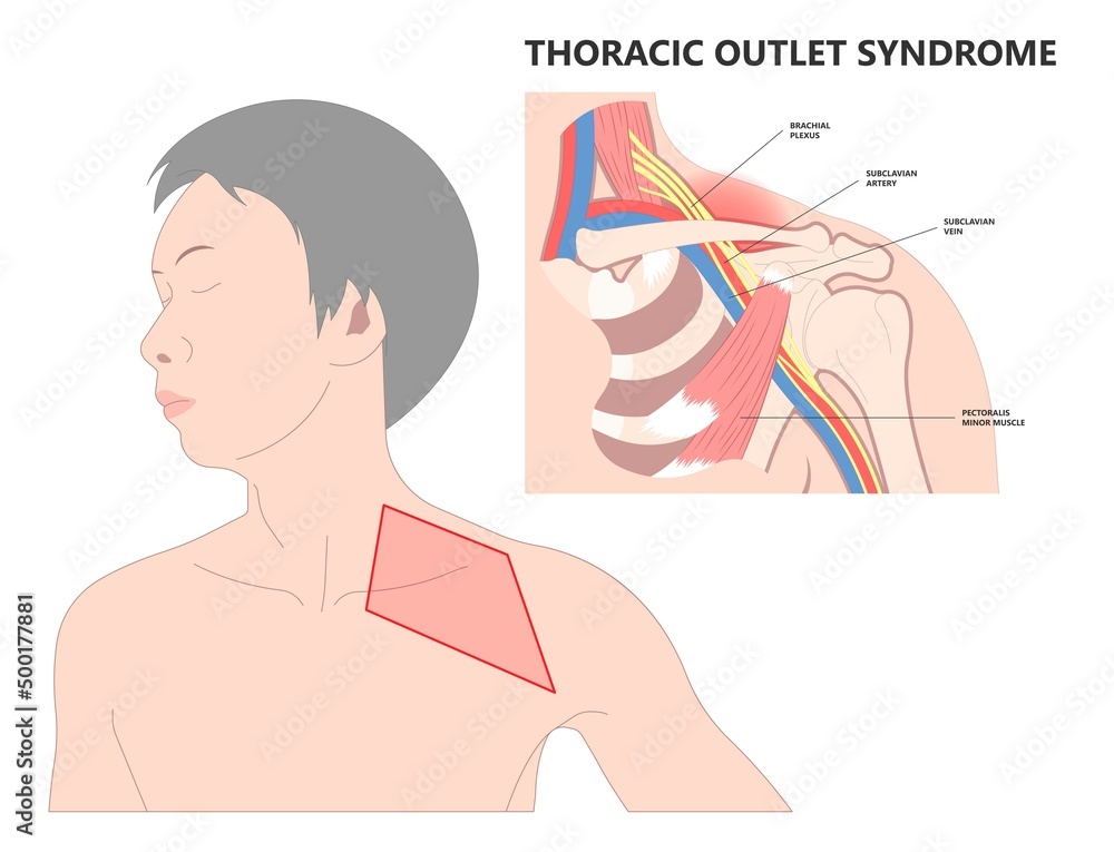 Lifting heavy objects trauma of pinched vagus nerve rib bone neck arm