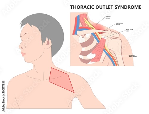 Lifting heavy objects trauma of pinched vagus nerve rib bone neck arm hand pain carpal tunnel outlet minor T4 poor artery blood clots Adson's test