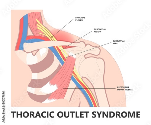 Trauma of pinched vagus nerve rib bone neck arm hand lifting heavy objects pain carpal tunnel outlet minor T4 poor artery blood clots Adson's test
