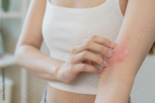 Dermatology asian young woman, girl allergy, allergic reaction from atopic, insect bites on her arm, hand in scratching itchy, itch red spot or rash of skin. Healthcare, treatment of beauty. © KMPZZZ