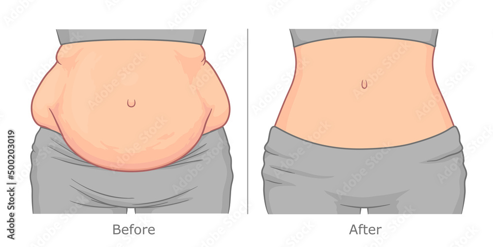 Woman's belly before and after weight loss. Vector illustration. - obrazy, fototapety, plakaty 