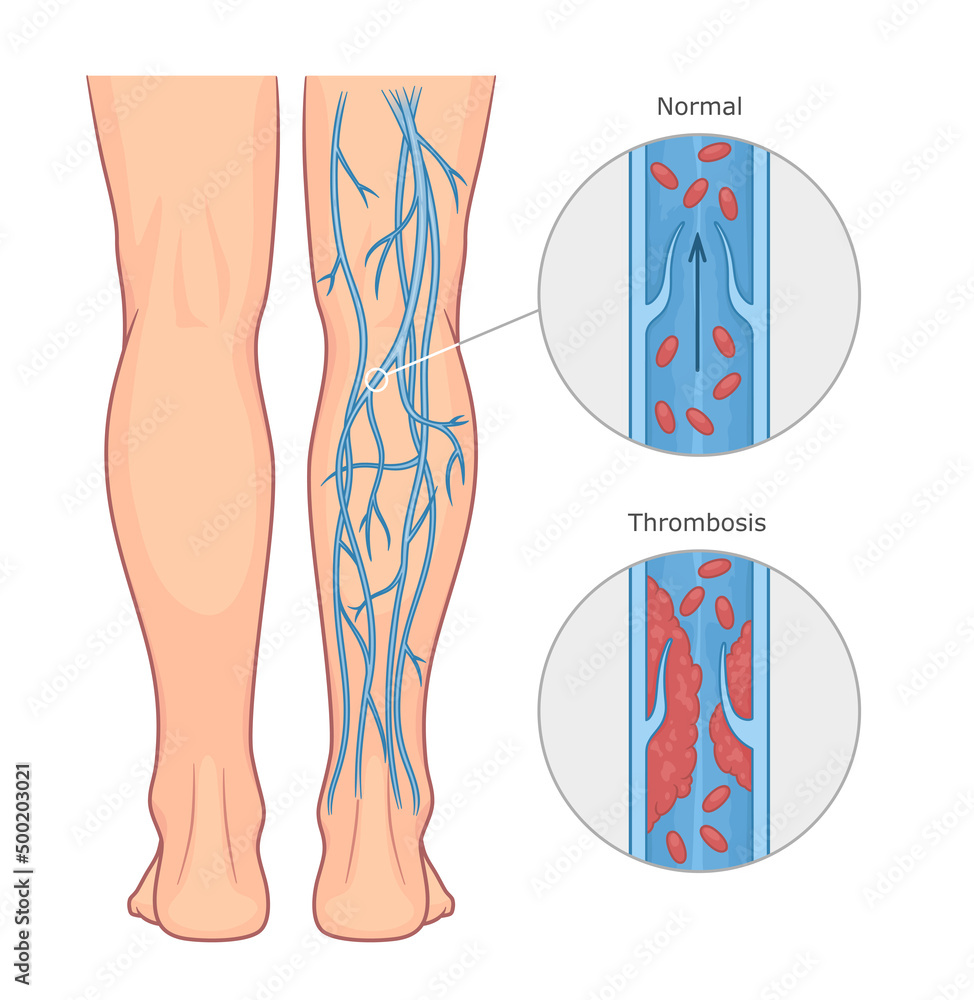 Deep vein thrombosis or DVT vector medical illustration. Healthy and unhealthy vein.  - obrazy, fototapety, plakaty 